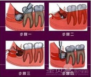 智齿的拔除步骤图解