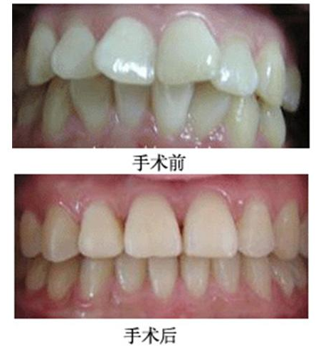 成都儿童牙齿矫正哪家医院好